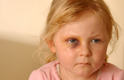 small girl with black eye